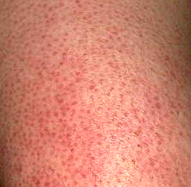 Skin Concerns Keratosis Pilaris Where Nothing Helps Getting Desperate Skincareaddiction